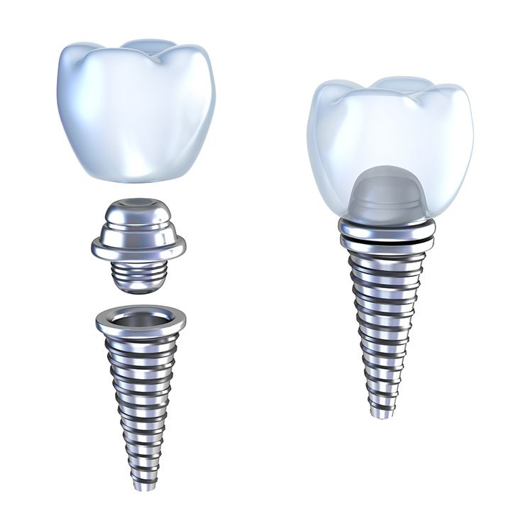Orlando FL Periodontist | 5 Ways Dental Implants Change Your Life
